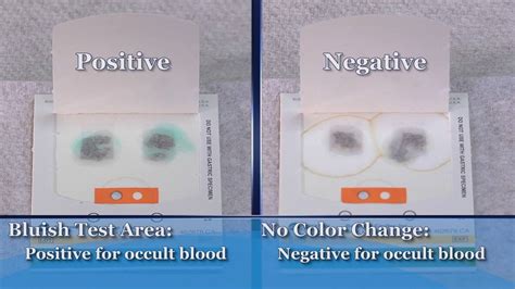 Positive occult blood icd 100